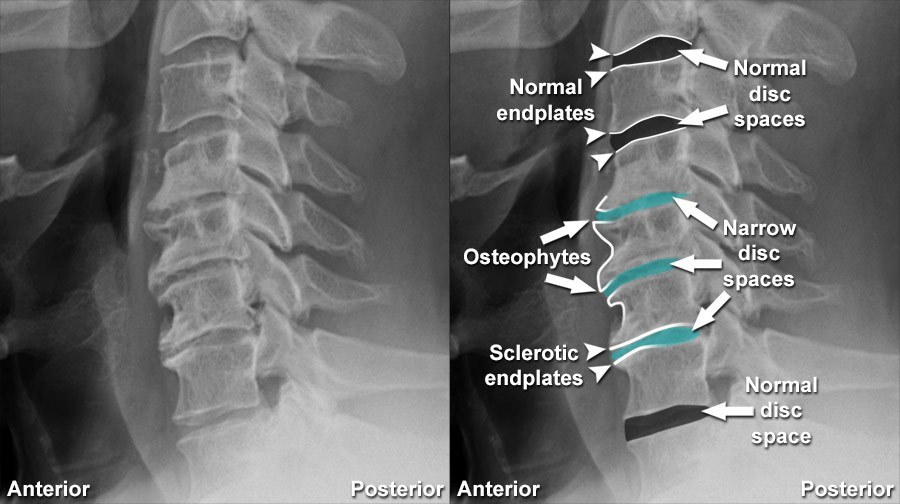 Does Your X-Ray/MRI Report Scare You? | The Hart Wellness Center