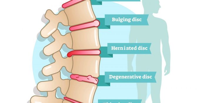 Everyone With Bulging Discs Has Pain…Right? image