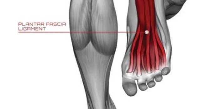 Do I Have Plantar Fasciitis Or Is It Something Else? image