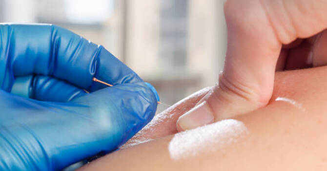 Kinetacore Functional Dry Needling image