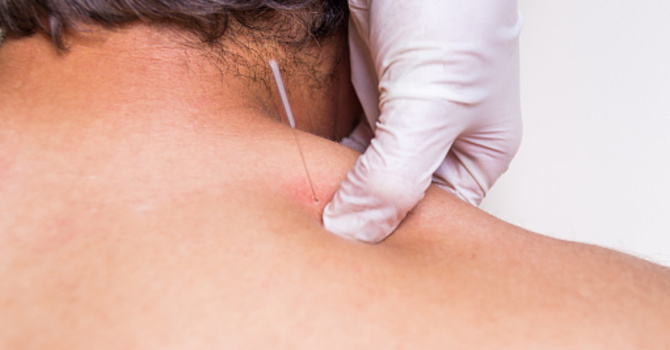 Functional Dry Needling (FDN)