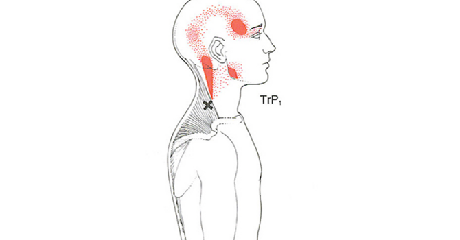 Are Tight Muscles Causing My Headaches? image