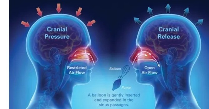 Nasal Release Technique